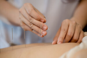 acupuncture-services